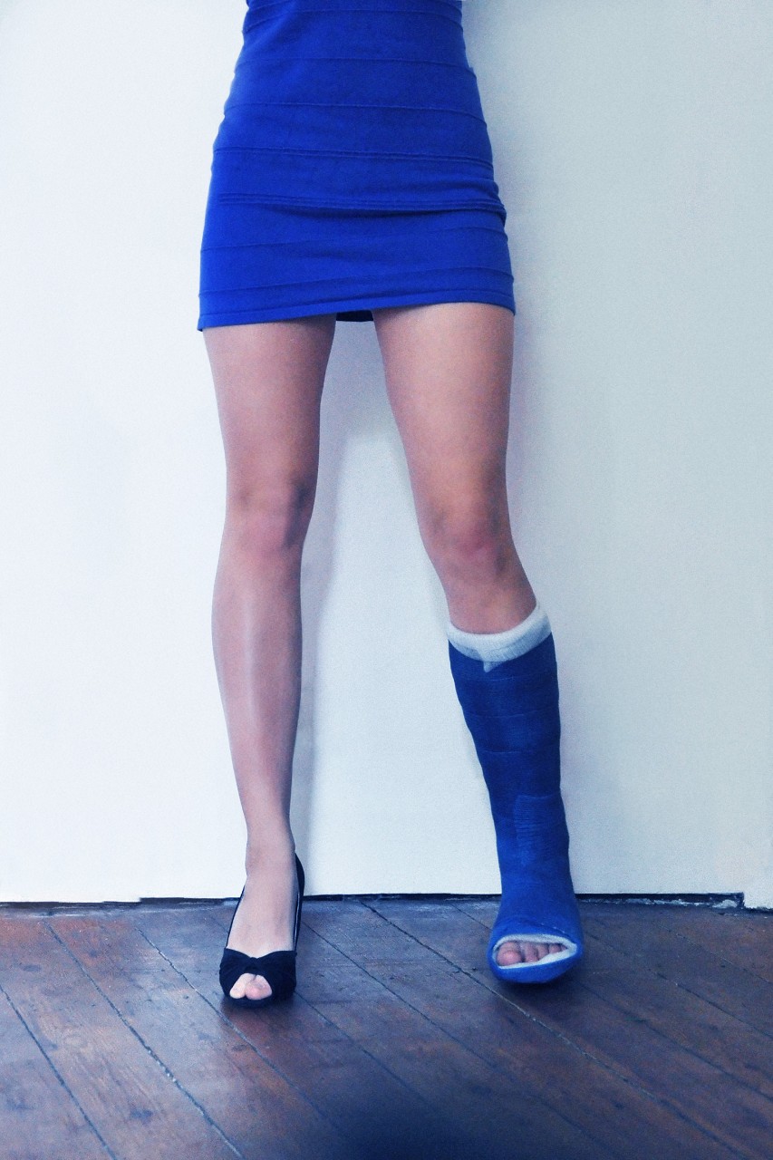 Untere Körperhälfte einer Frau mit blauem Minikleid, das linke Bein in einem blauen Gips passend zum Kleid.